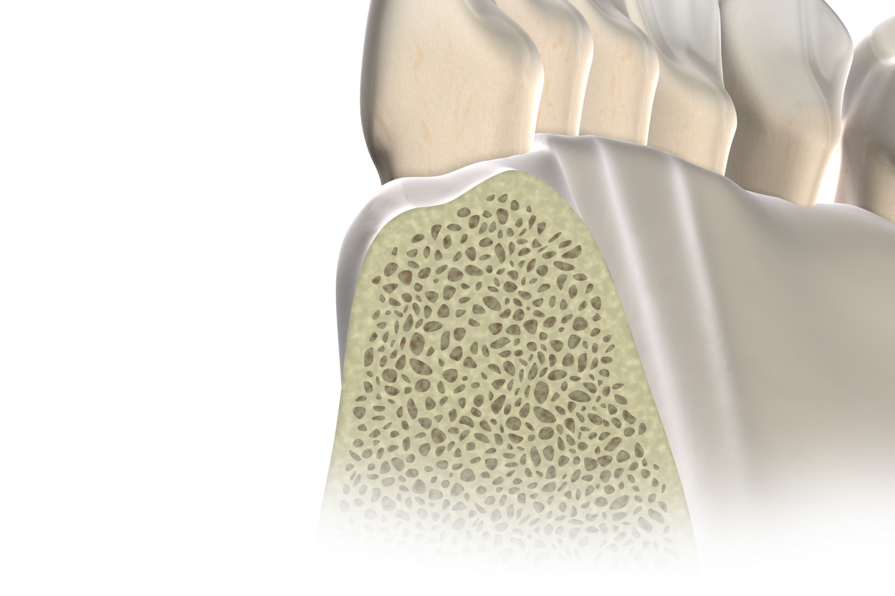 Isolated apicoectomy