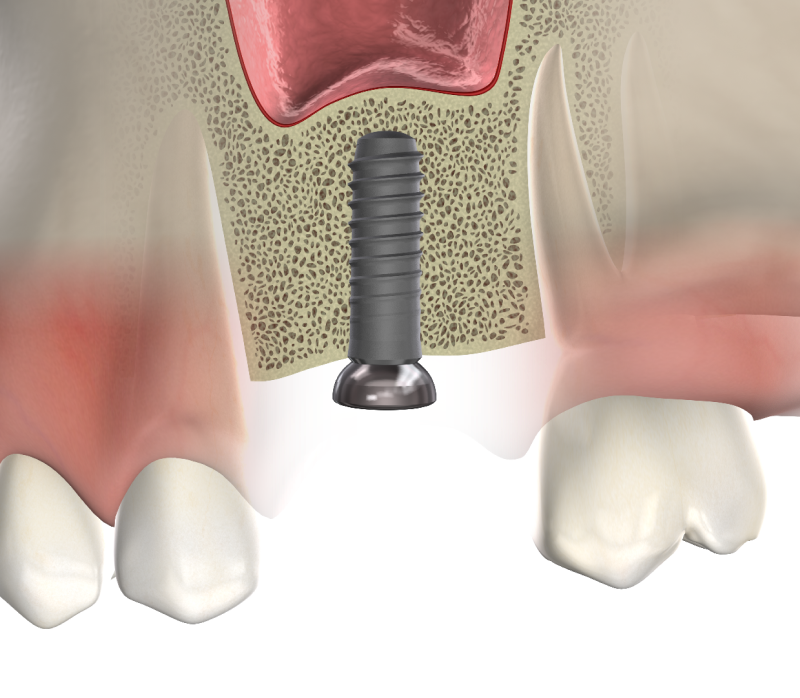 Isolated bone grafting mobile