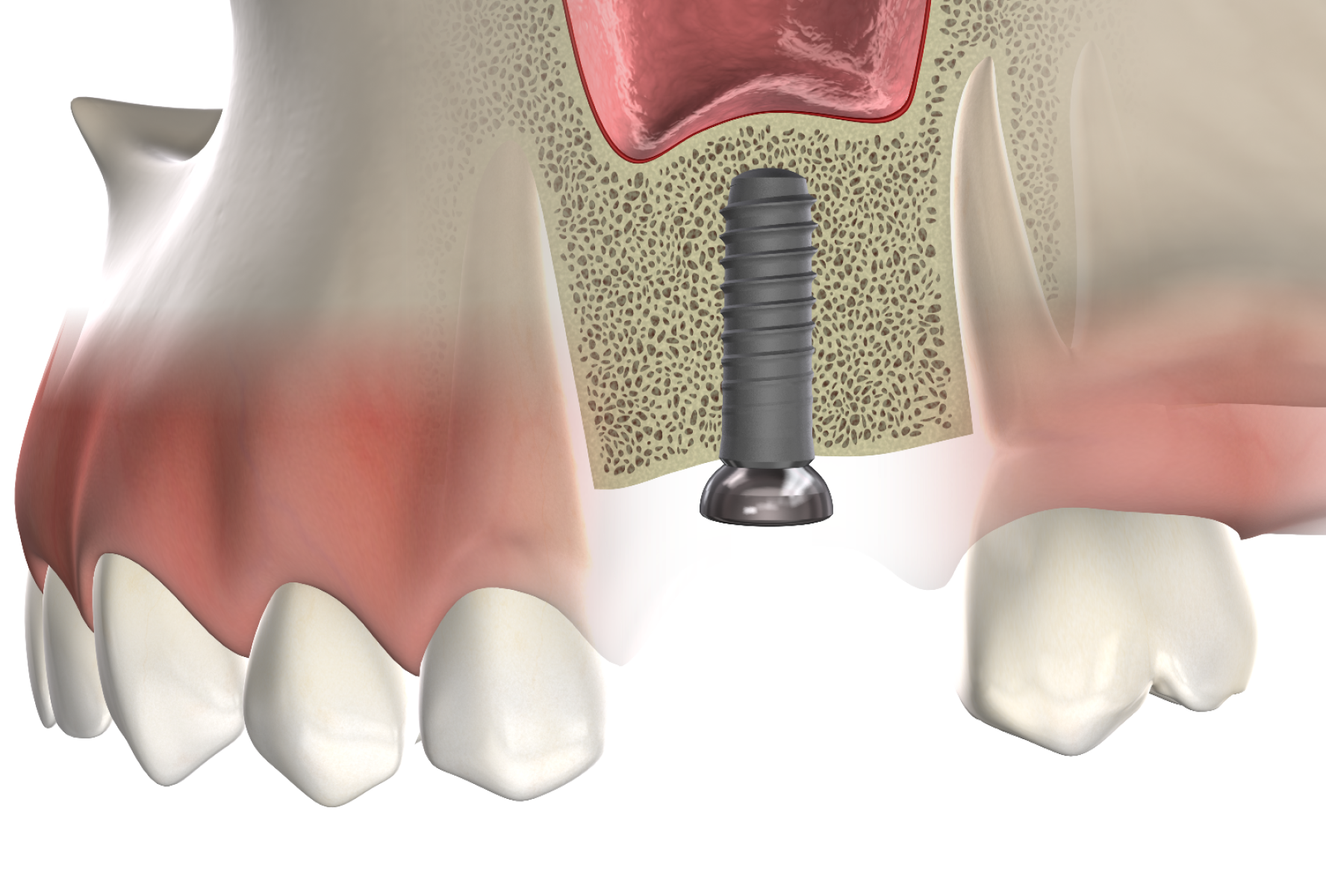 Isolated bone grafting