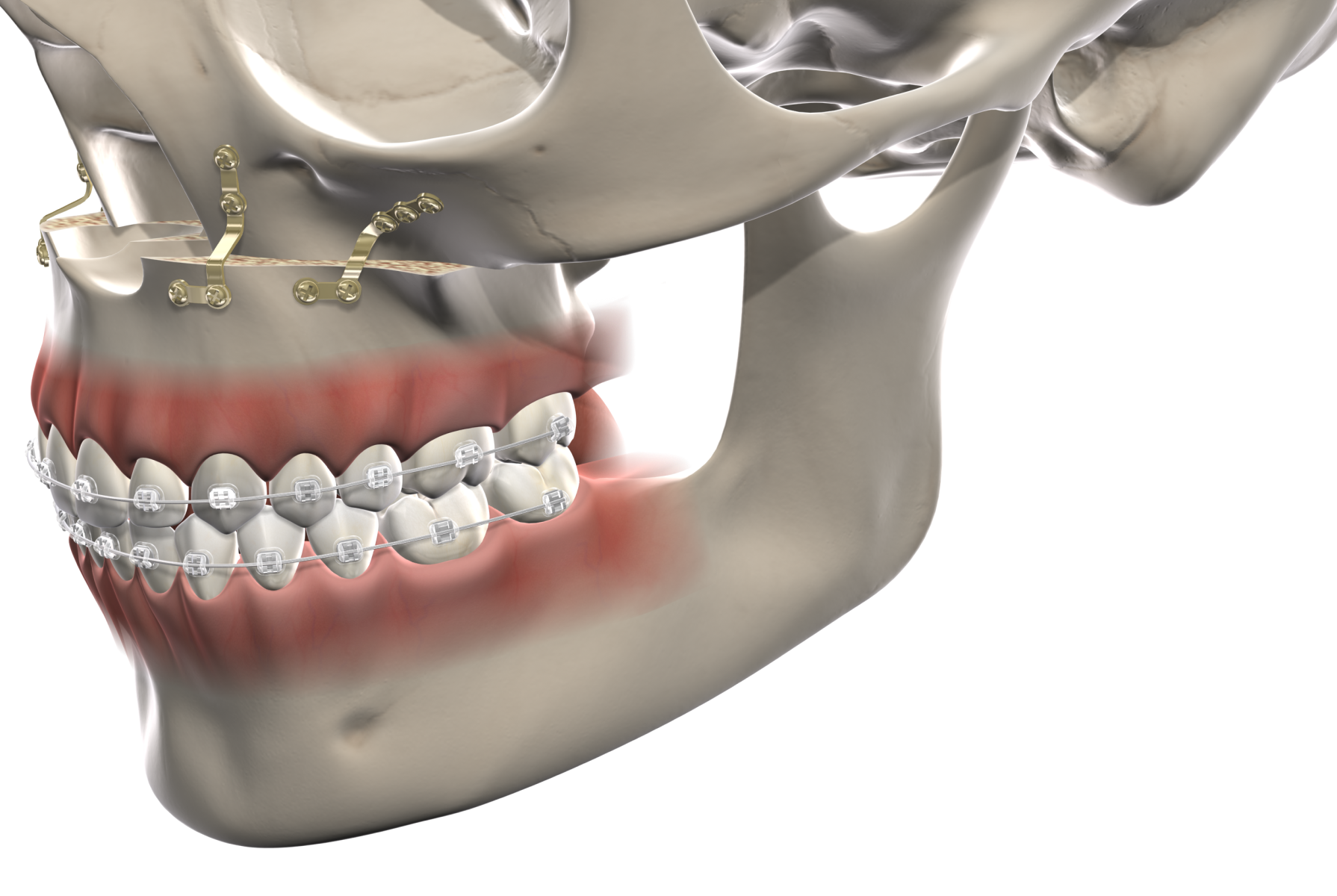 Isolated facial trauma