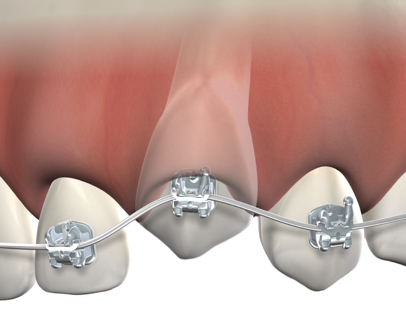 Isolated impacted tooth mobile
