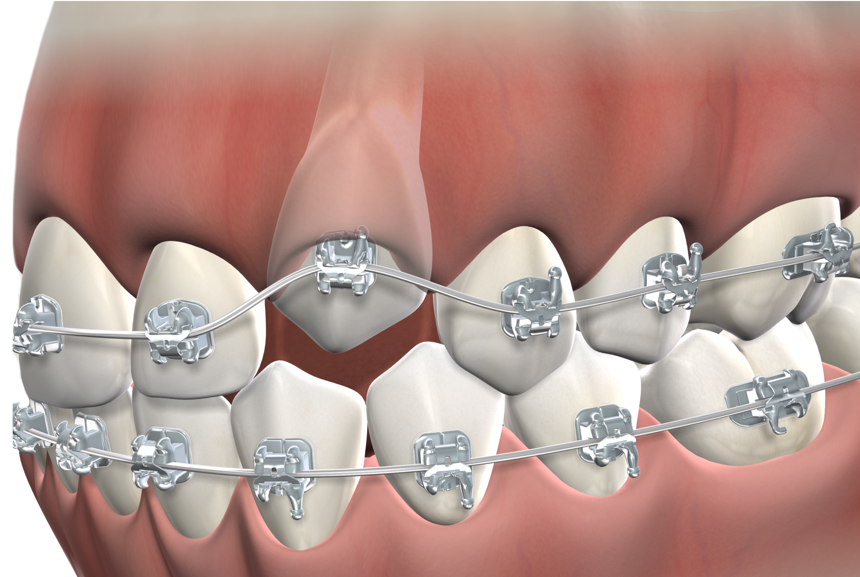 Isolated impacted tooth