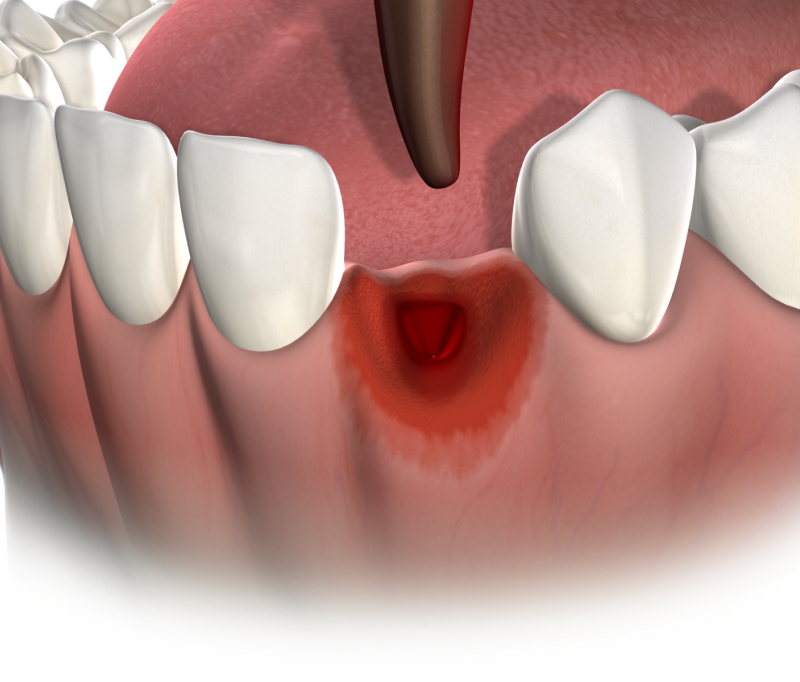 Isolated tooth extractions mobile