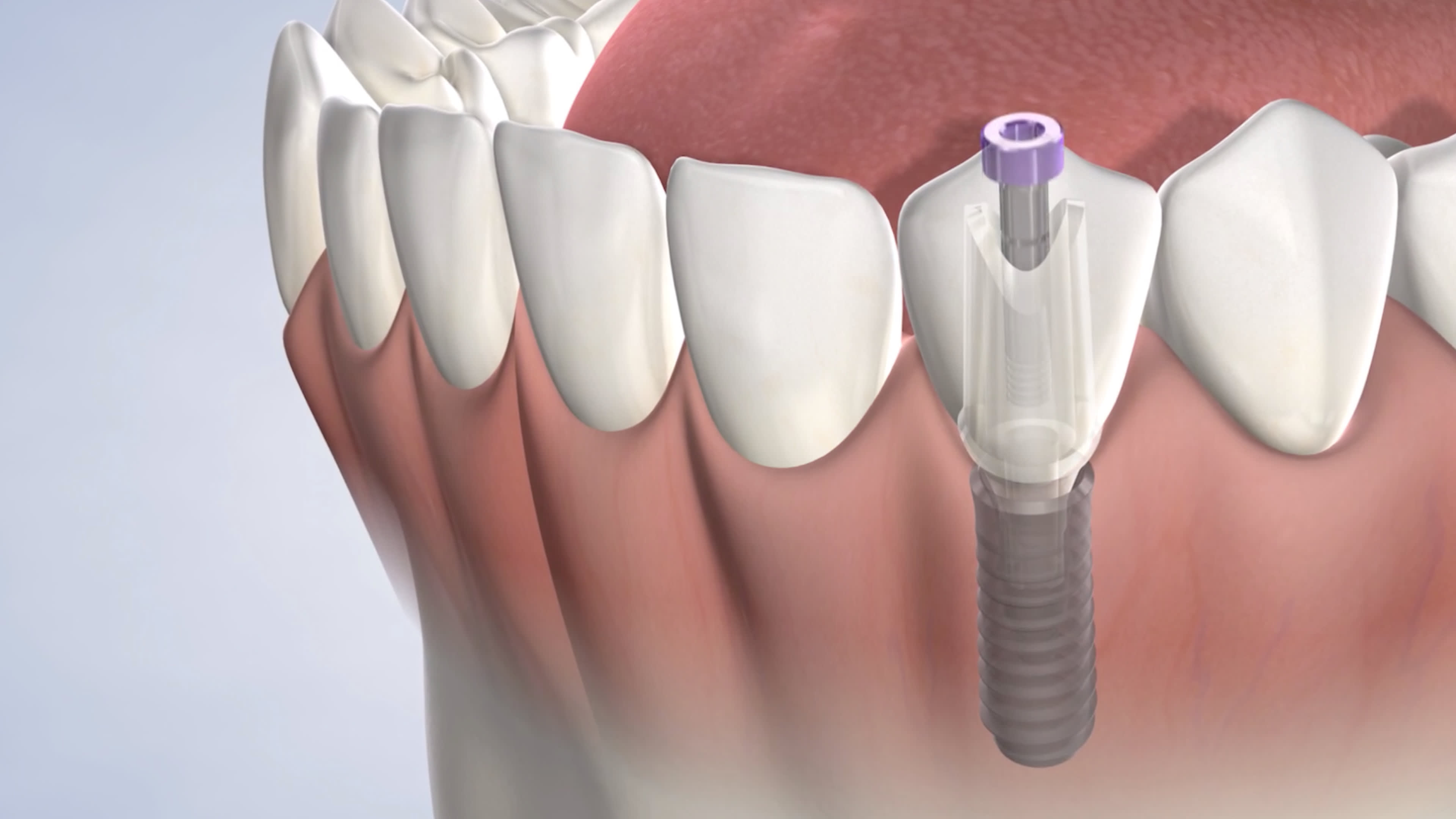 Dental implant instructions