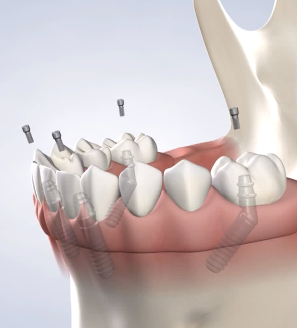 All-on-4 treatment concept in Ann Arbor, Adrian, Plymouth, and Dexter, MI
