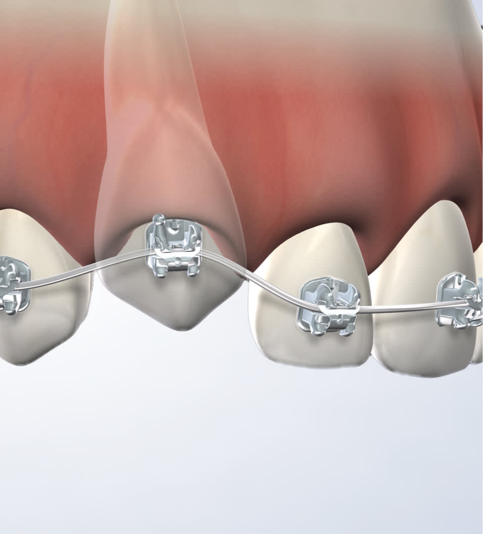 Impacted canine treatment in Ann Arbor, Adrian, Plymouth, and Dexter, MI