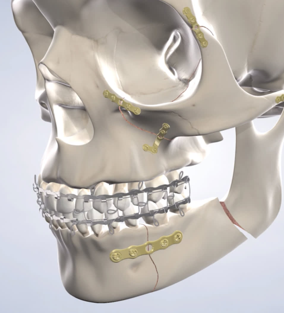 Facial trauma treatment in Ann Arbor, Adrian, Plymouth, and Dexter, MI